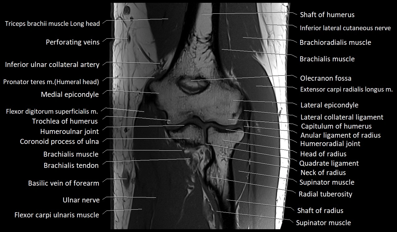 Elbow coronal anatomy image  cross sectional 3T MRI image 20.webp